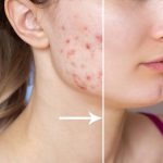 7 Cara Menghilangkan Bekas Jerawat dengan Cepat