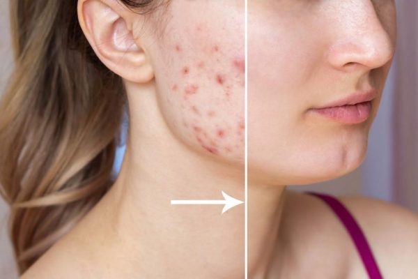7 Cara Menghilangkan Bekas Jerawat dengan Cepat 7 Cara Menghilangkan Bekas Jerawat dengan Cepat