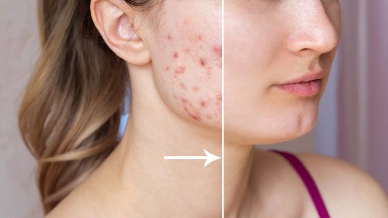 7 Cara Menghilangkan Bekas Jerawat dengan Cepat