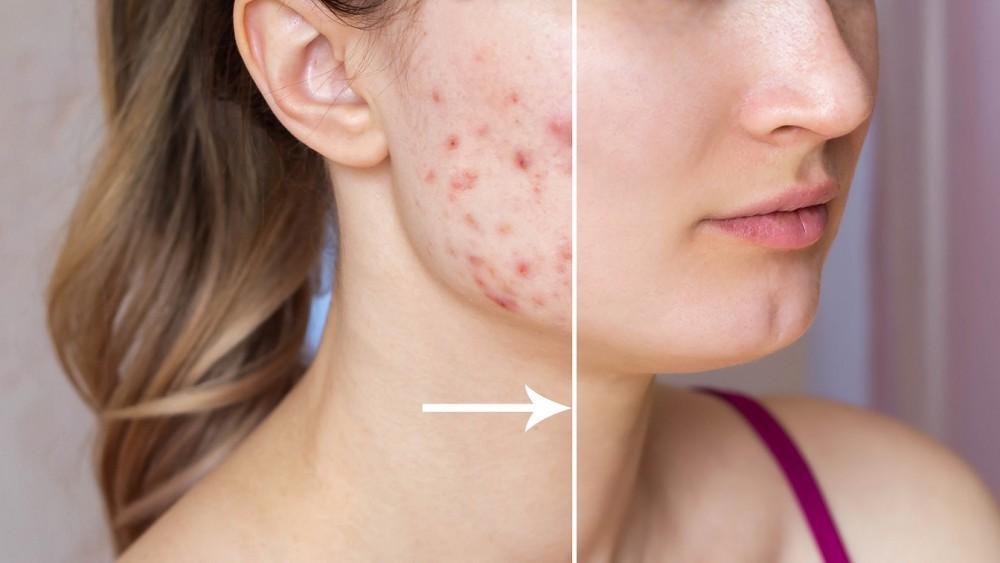 7 Cara Menghilangkan Bekas Jerawat dengan Cepat