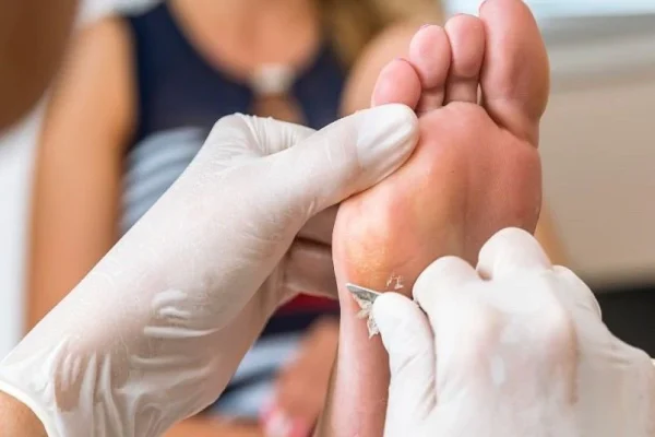 7 Cara Menghilangkan Kapalan di Telapak Kaki 7 Cara Menghilangkan Kapalan di Telapak Kaki