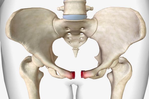 10 Langkah Pemulihan Cepat Setelah Cedera Panggul