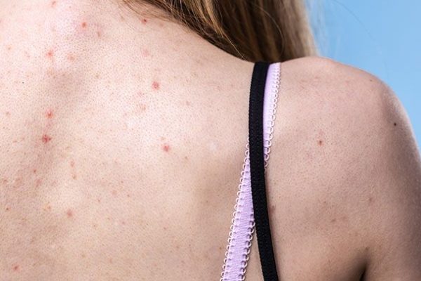 5 Cara Mengobati Jerawat Punggung Secara Efektif