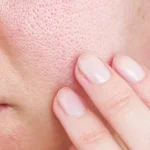 5 Hal yang Bisa Merusak Kesehatan Kulit Dagu