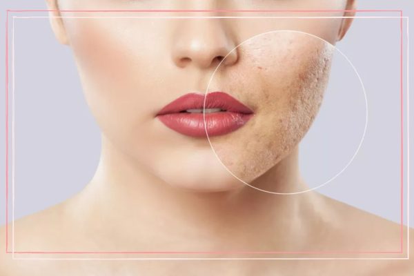 7 Langkah Menghilangkan Bekas Jerawat di Dagu