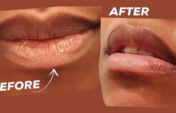 5 Cara Menyingkirkan Kulit Mati di Bibir Tanpa Sakit