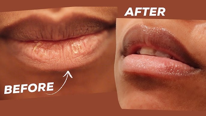 5 Cara Menyingkirkan Kulit Mati di Bibir Tanpa Sakit